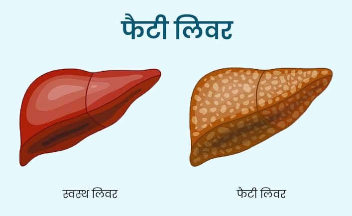 फैटी लीवर